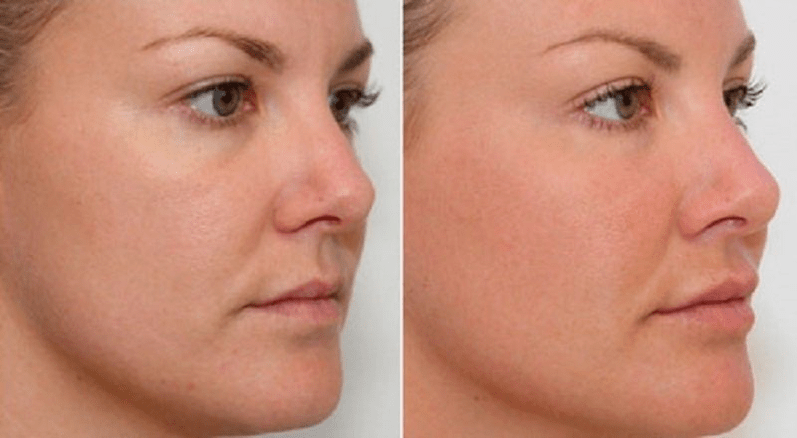 Before and after using intenskin