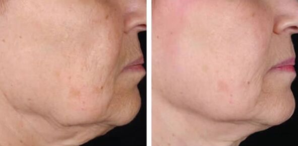 before and after laser skin rejuvenation photo 3