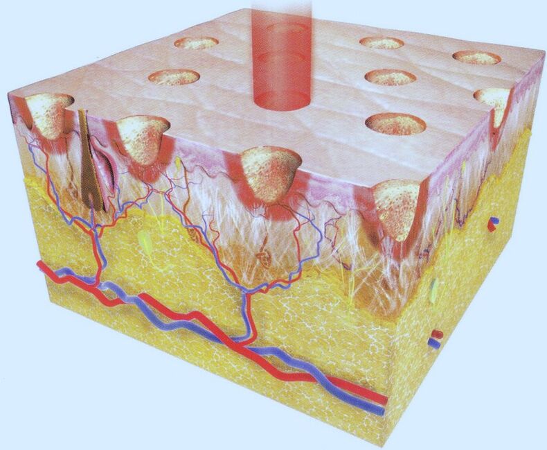 fractional laser thermolysis