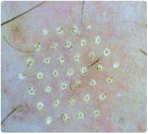 skin under a microscope after fractional rejuvenation