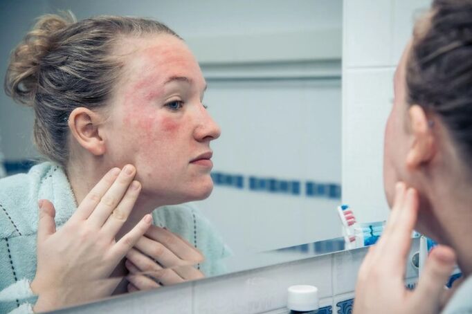Chronic skin diseases in the aggravation phase