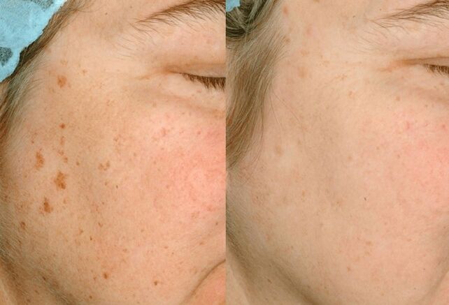 Removal of pigmentation on the skin