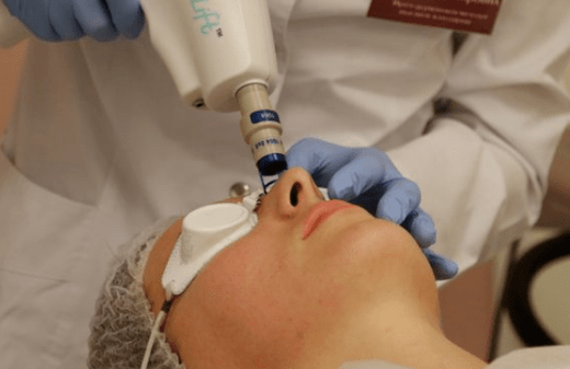 Non -skilled laser rejuvenation